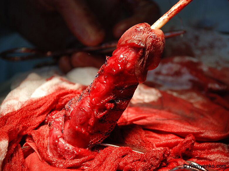 kollageenmaatriksi paigaldamine peenise suurendamiseks