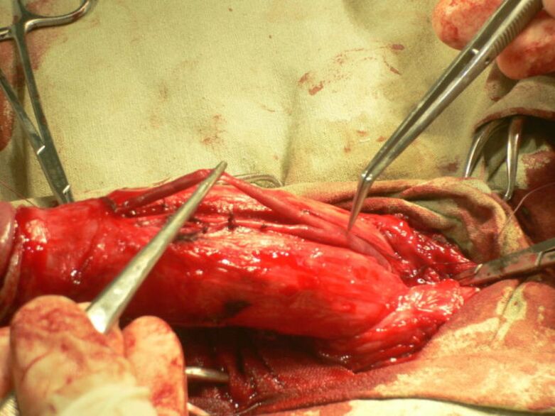 peenise lipotäitmine suurendamiseks