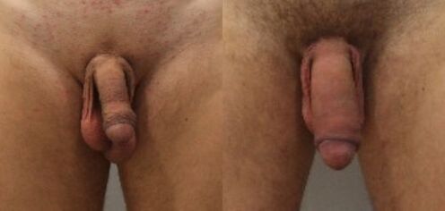 enne ja pärast peenise suurendamise operatsiooni