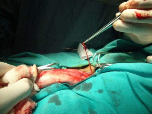 peenise suurendamise operatsioon