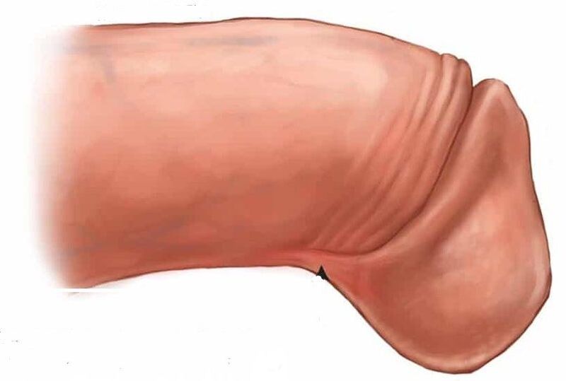 kuidas suurendada peenist glansi